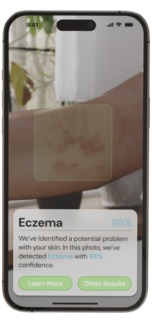 A girl is using the Rash ID app to diagnose a skin disorder on her hand